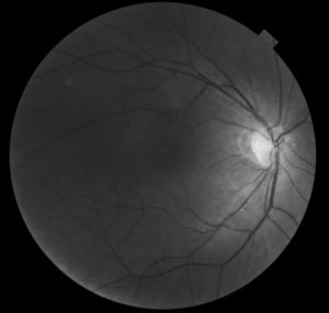 retinalholeblack-300x286