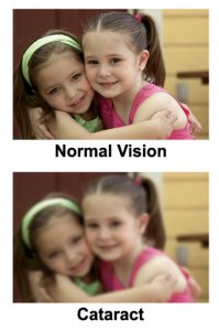 cataract (1)